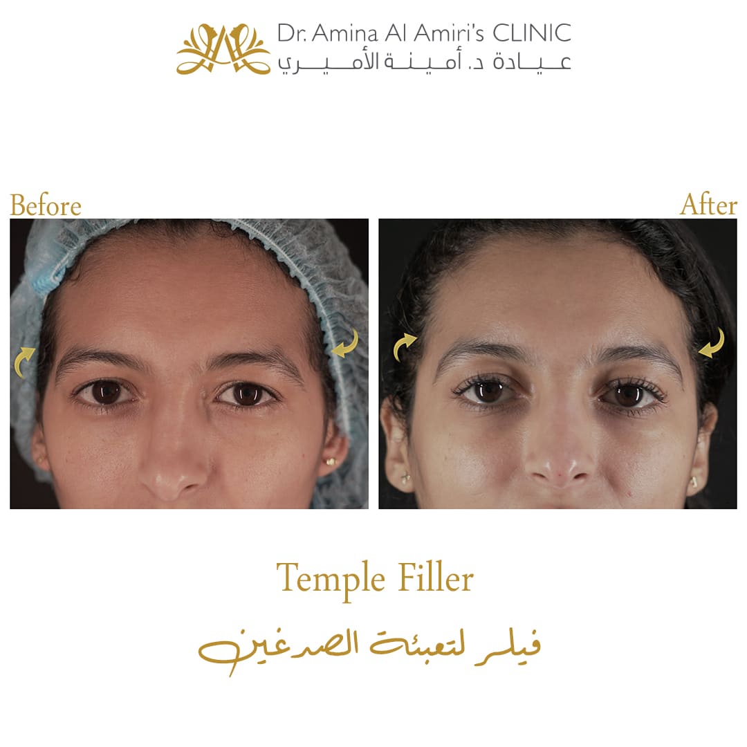Temple filler - before and after