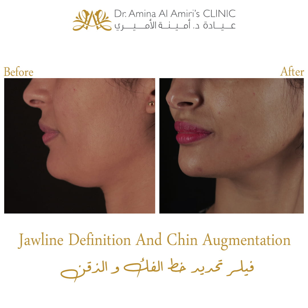 Jawline and chin definition - before and after