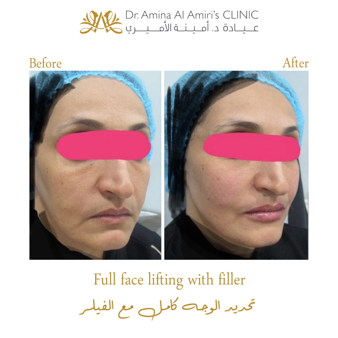 Face lifting with filler - before & after
