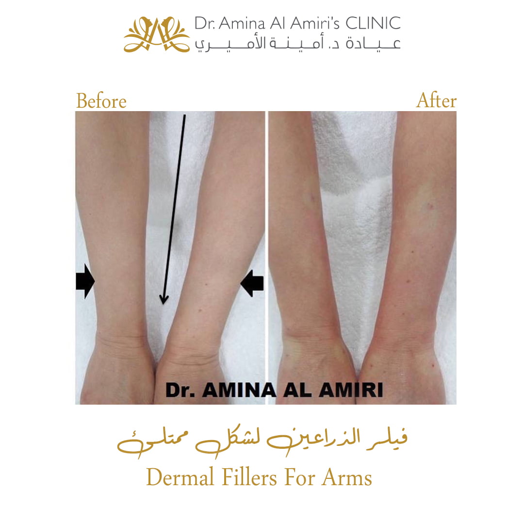 Dermal fillers for arms - before & after