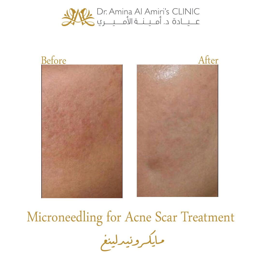 Microneedling for acne scars - before & after