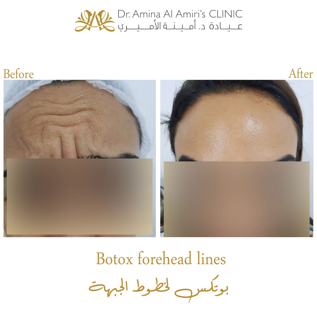 Botox for forehead - before & after