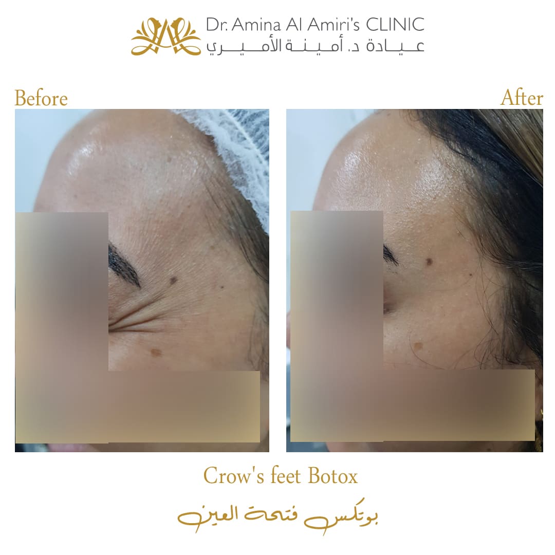 Crow's feet botox - before & after