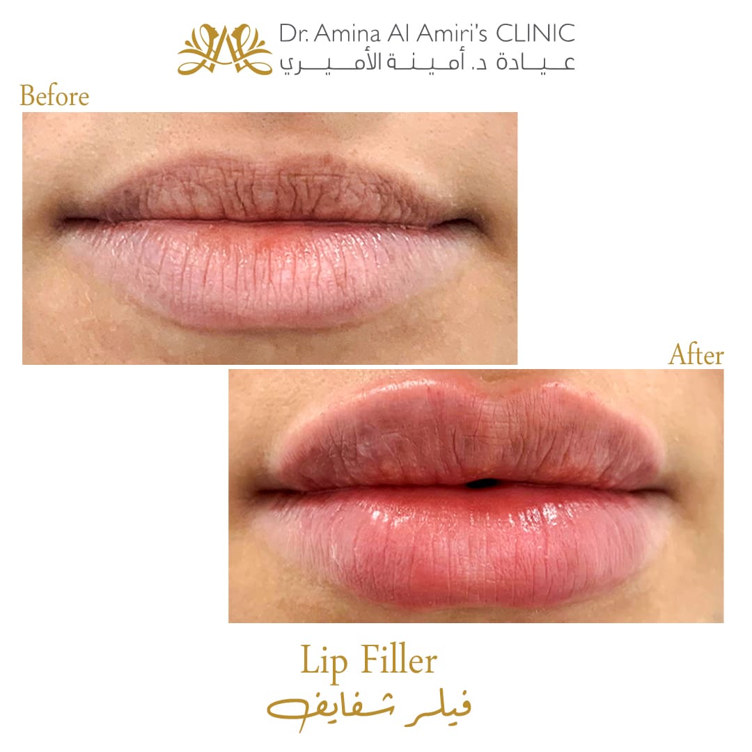 Lip filler - before & after