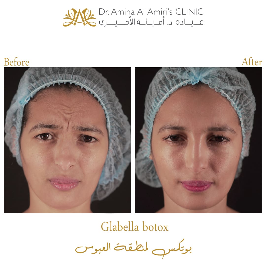 Glabella botox - before & after