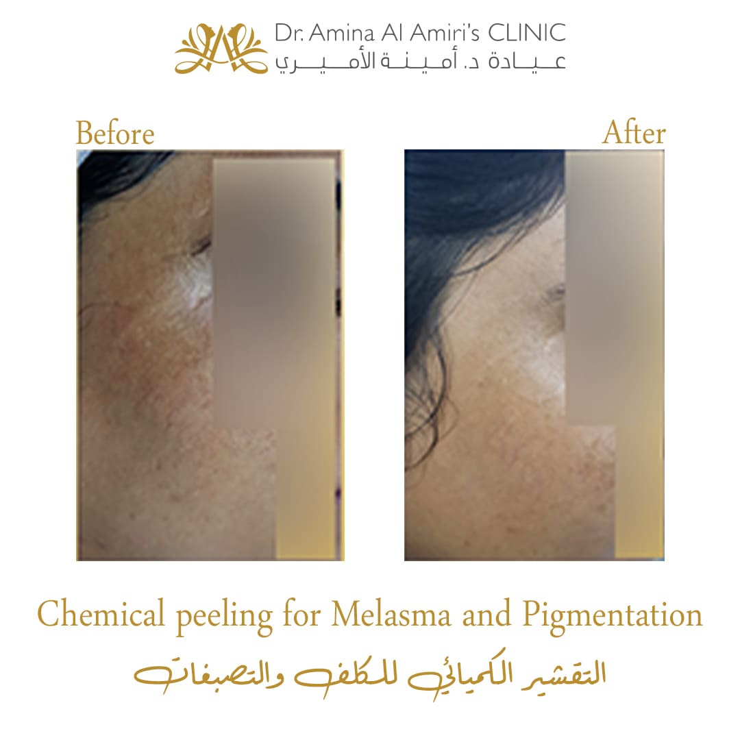 Chemical peeling for pigmentation - before and after