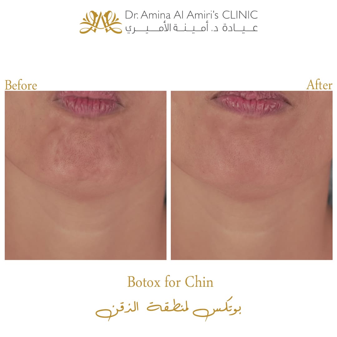 Botox for chin - before & after