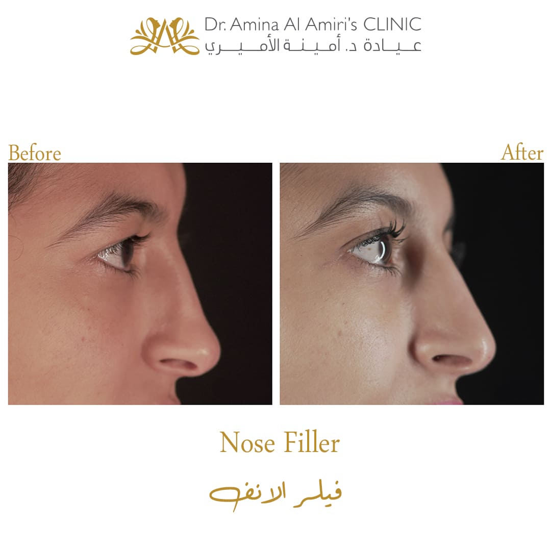 Nose filler - before & after