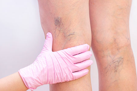 Sclerotherapy for varicose & spider veins