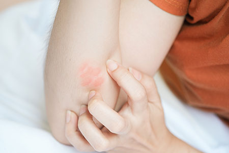 Dermatitis treatments in Dubai